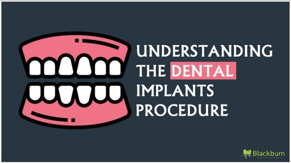 Understanding The Dental Implants Procedure Understanding the dental implants procedure-2