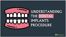 Understanding The Dental Implants Procedure