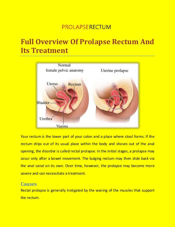 Prolapse Rectum Treatment Full Overview of Prolapse Rectum And Its Treatment