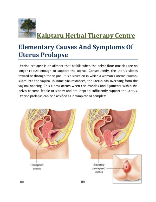 Kalptaru Herbal Therapy Centre Herbal Treatment of Uterus Prolapse