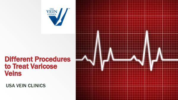 Varicose Veins Treatment Procedures - USA Vein Clinics Varicose Veins Treatment Procedures