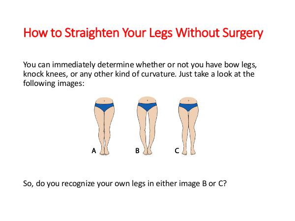 How To Straighten Legs Knock Knees Without Surgery How To Straighten Legs Knock Knees Without Surgery