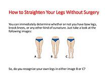 How To Straighten Legs Knock Knees Without Surgery