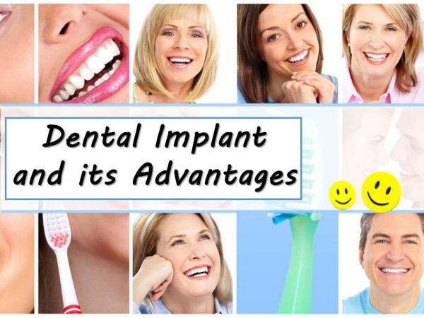 Dental Implant and its Advantages Dental Implant and its Advantages