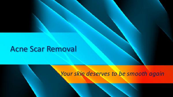 Acne Scar Removal - Guide to Treating Acne Scars Acne Scar Removal