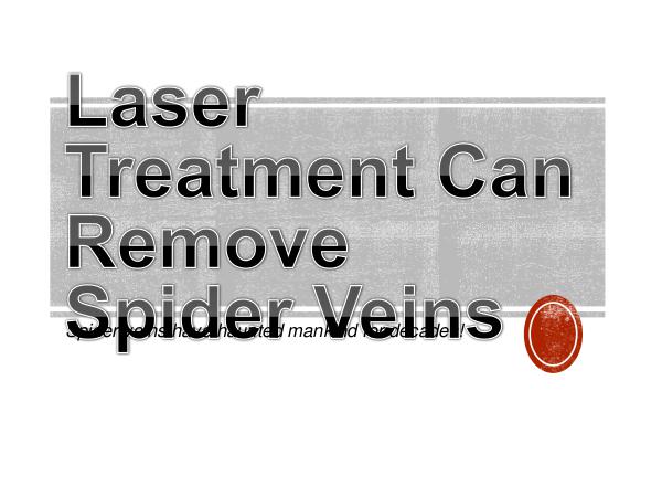Laser Treatment Can Remove Spider Veins