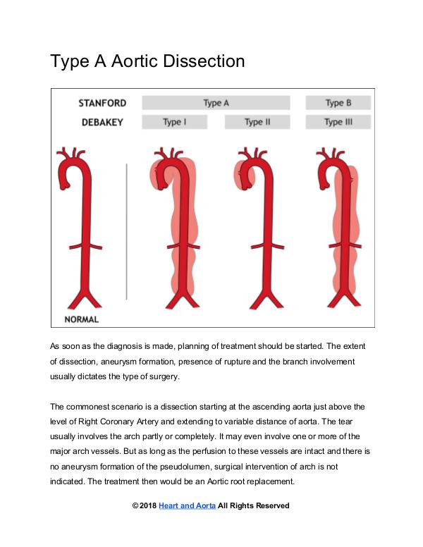 Type A Aortic Dissection