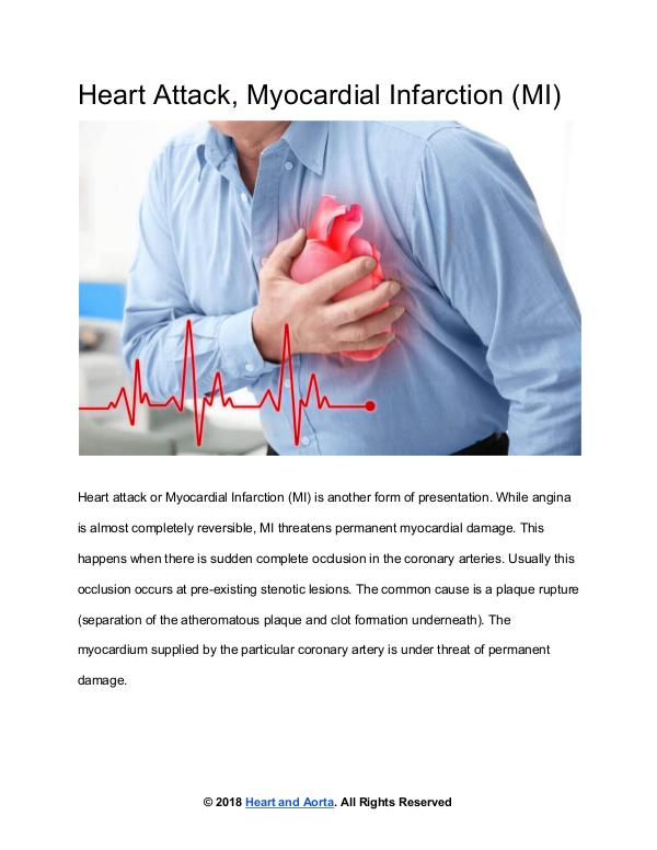 Heart Attack or Myocardial Infarction (MI)