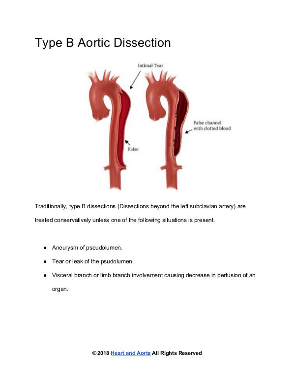 Type B Aortic Dissection