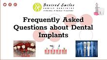 What are Some Frequently Asked Questions about Dental Implants
