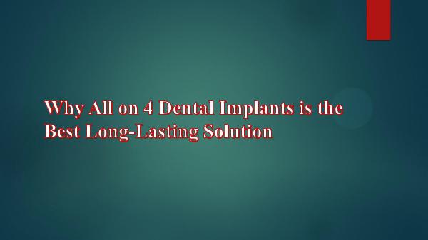 Why All on 4 Dental Implants is the Best Long-Last