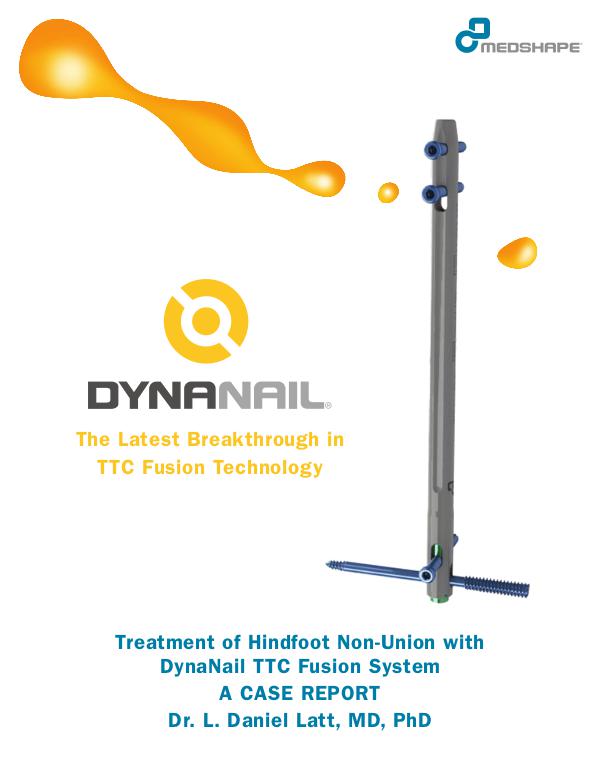 TTC & Hindfoot Fusion | Case Report – DynaNail® TTC Fusion System TTC And Hindfoot Fusion  Case Report DynaNail TTC